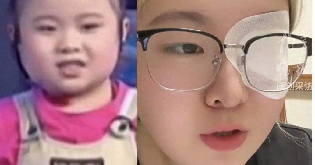 知名童星“秦虹一枝花”右眼失明